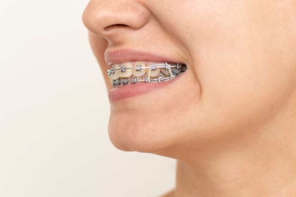 LES ÉLASTIQUES EN ORTHODONTIE